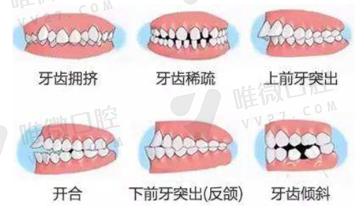 种牙镶牙和安假牙的区别,板牙可以安假牙吗(图1)